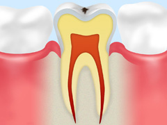 ごく初期の虫歯