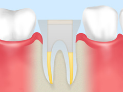 根管治療