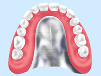 金属床入れ歯