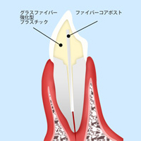 セラミック治療を引き立てる土台「ファイバーコア」