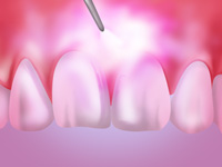 歯周病にレーザー治療を採用